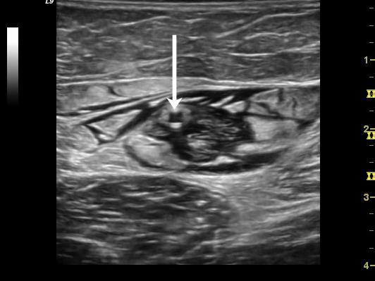 PROCEDURE- ALGEMEEN Tafel in trendelenburg nstilleren van tumescentie onder echogeleide Vene min 1 cm