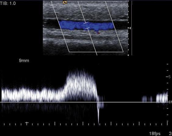 DAGNOSTEK Anamnese Klachten Risicofactoren Klinisch >nspectie en palpatie varices