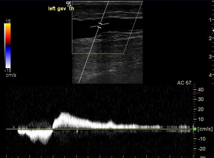 5 s Nagaan etiologie > Obstructie? Reflux?