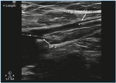 Positioneren van de catheter op 1 cm van saphenofemorale