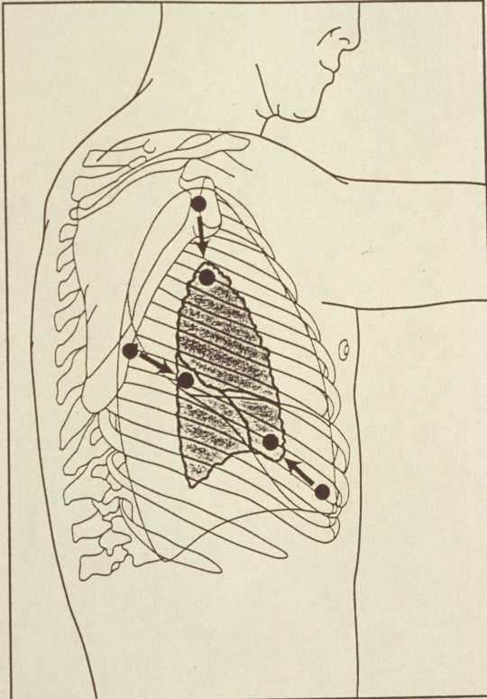 thoracotomy