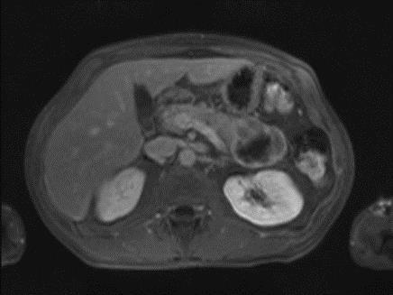 Casus Gastroenteroloog ivm buikpijn Gastroscopie