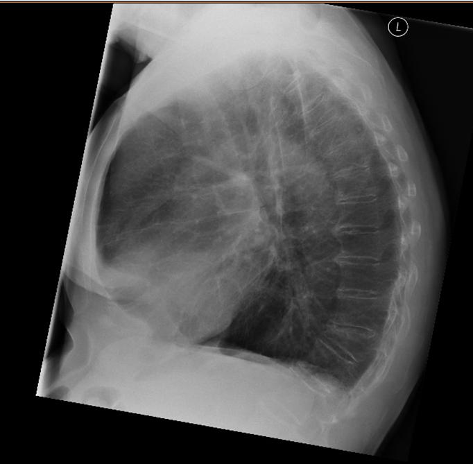 Aug 2017 policontrole: zichtbaar gewichtsverlies. X- thorax laten verrichten voor screening op longmaligniteit.
