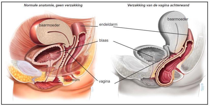 U heeft een verzakking van de vagina-achterwand met daarachter de darm. De operatie om dit te verhelpen heet achterwandplastiek. In deze folder leest u meer over deze ingreep.