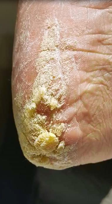 Dermoleen Cream aanbrengen Bij een harde of erg droge huid;