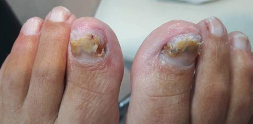 huid heen gaat en zo bij de matrix van de nagel zijn werking kan doen Onychomycose gaat bijna altijd