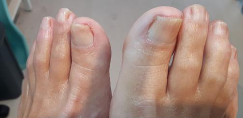 in 6 maanden Onychomycosis met bacterie Voetzorg Reggeland, Rijssen Wist u dat 1 op de 3 visuele