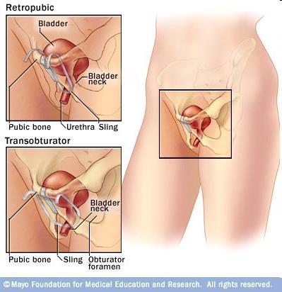 Behandeling: Stressincontinentie Operatief: principe: stabilisatie urethrapositie om goede