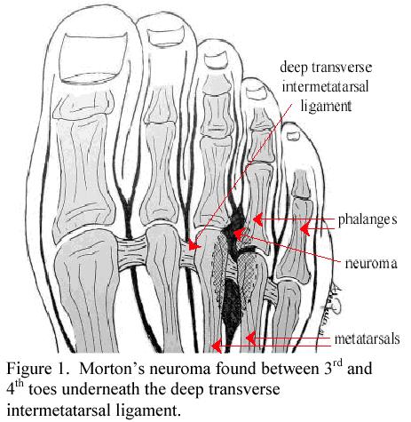 Morton 72