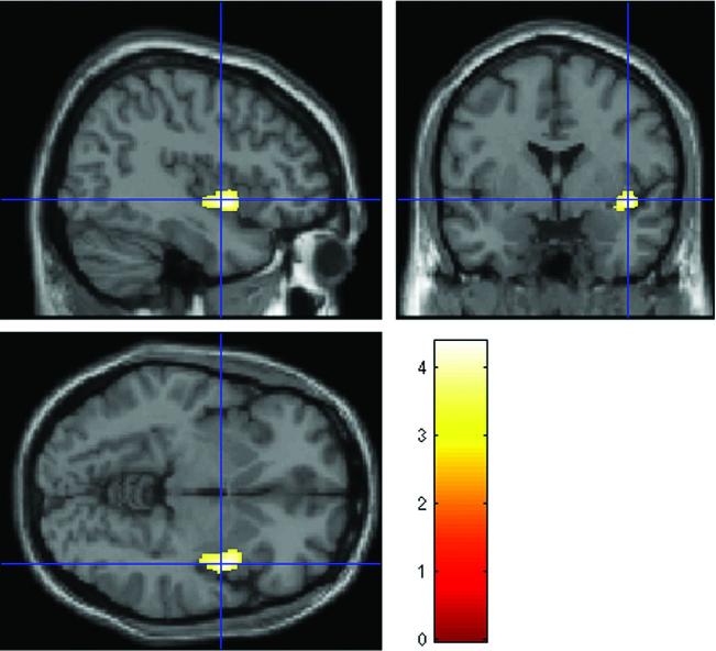 Insula (fmri) Toen hersenwetenschappers consumenten in de hersenscanner legden, viel hun iets geks op. In bovenstaande scan zien we de hersenen van een consument terwijl hij naar een prijs keek.