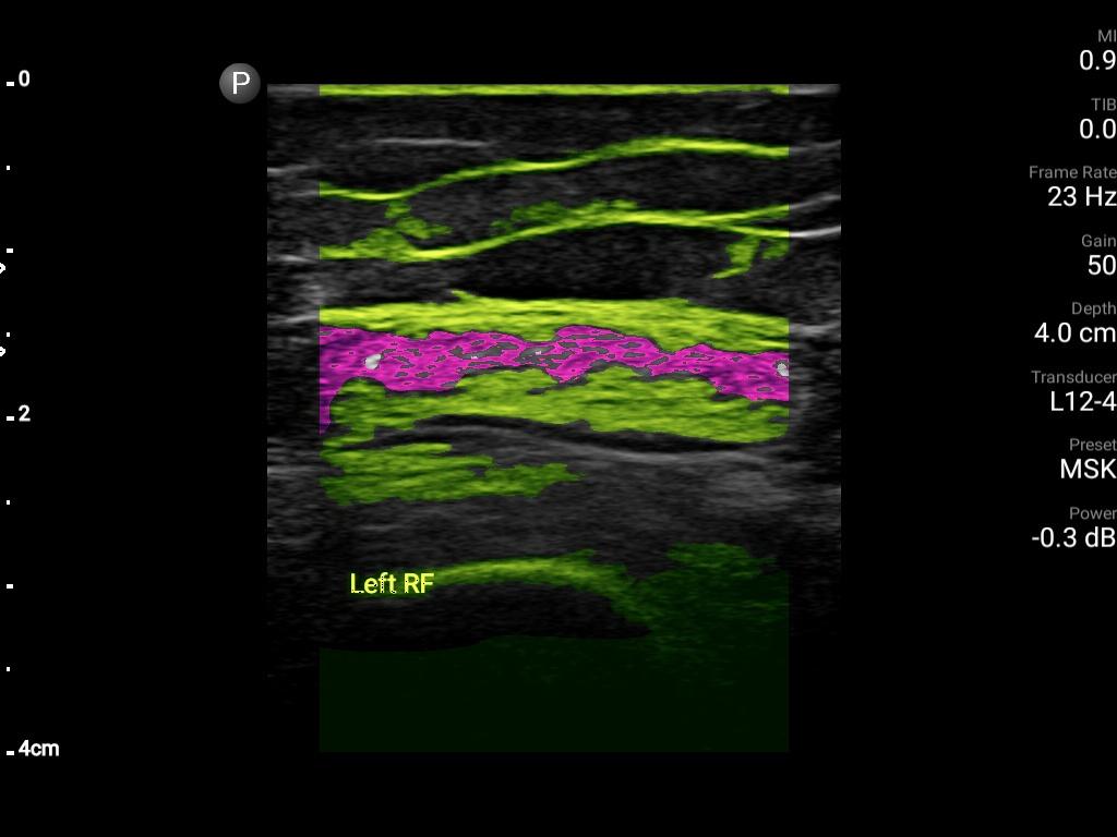 Muscle Quality Echo