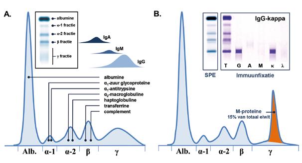 Figuur 1 Serumeiwitelektroforese en immuunfixatie. A) Normaal patroon. Na scheiding en kleuring wordt het eiwitspectrum (SPE) op de agarose-gel zichtbaar (insert).