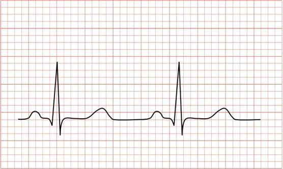 Als u ouder bent dan 50 jaar, wordt op de functieafdeling van tevoren ook een ECG (hartfilmpje) gemaakt. Op een ECG wordt geregistreerd hoe de elektrische puls zich door uw hart verspreidt.