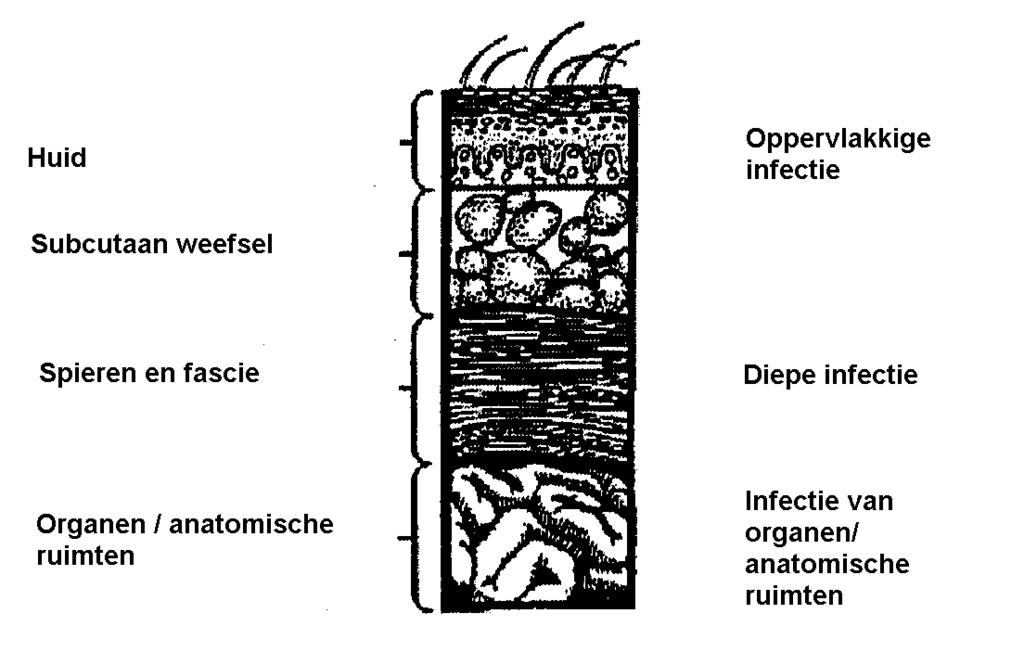 1 Postoperatieve infecties van het operatiegebied Postoperatieve infecties van het operatiegebied worden onderverdeeld in: oppervlakkige postoperatieve wondinfectie; diepe postoperatieve