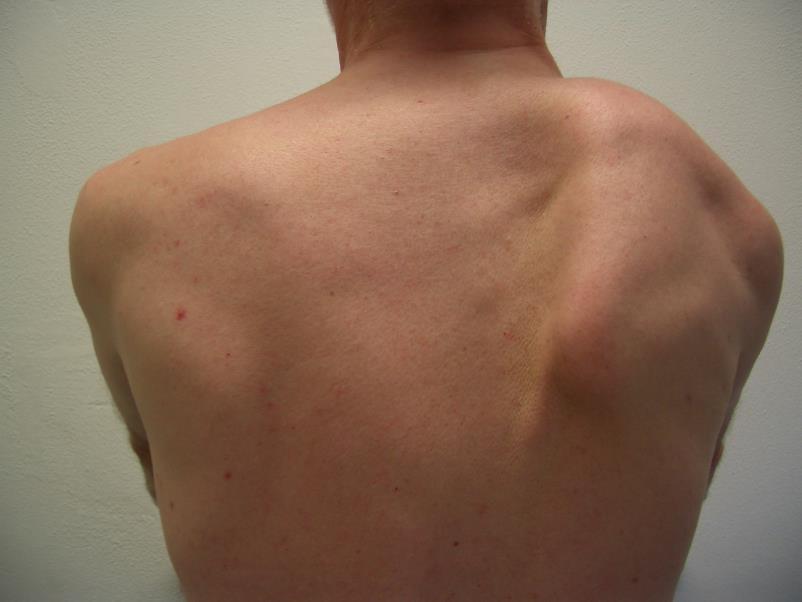 Meer klinische kenmerken Vlekkige hypesthesie in 80% Zelden tot nooit gestoorde propriocepsis Scapula instabiliteit niet