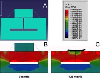 Afbeelding 5. Finite Element Analysis model 1: een 2 mm brede incisie loopt van het huidoppervlak tot aan de holte (A).