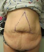 Casestudy 4: Buikwandreconstructie (afbeelding 11) Een 38-jarige obese vrouw onderging een abdominale Fleur-de-Lis-stijl