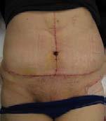 Buikwandreconstructie bij 38-jarige vrouwelijke patiënt. (A) Chirurgische markeringen voorafgaand aan chirurgie.
