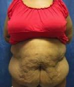 Casestudy 5: Panniculectomie (afbeelding 12) Een obese vrouw gepresenteerd met terminaal nierfalen.