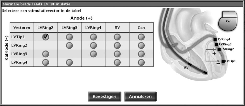 2-84 Stimulatietherapieën Atriale informatie gebruiken VOORZICHTIG: Als een LVRing4>>RV-stimulatieconfiguratie is geprogrammeerd met een IS4-LLLL-lead, kan de LV-tip worden gebruikt als anode in