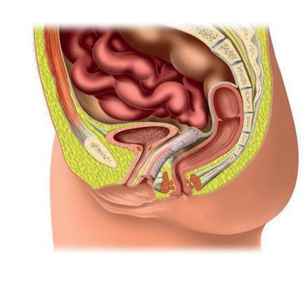 Schedetop Sacrocolpopexie Bij een verzakking van de vaginakoepel wordt deze via een kijkoperatie of via een open buikoperatie aan het heiligbeen (sacrum) gehecht. Hiervoor wordt een mesh gebruikt.