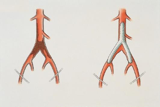 2 De operatie De operatie vindt plaats onder algemene verdoving. Voor het aanleggen van de bypass zal men gebruik maken van een vaatprothese.