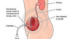 CONTINENTE STOMA INDICATIE Na