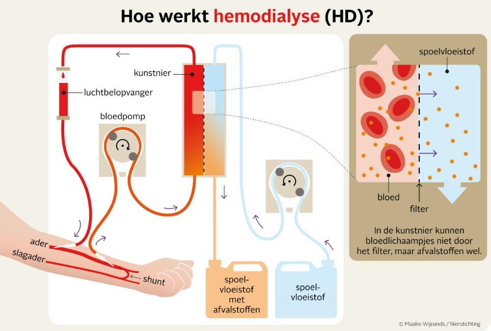 Hemodialyse Het principe van hemodialyse Dialyse komt van het Griekse werkwoord 'dialuo', dat verwijdering betekent.