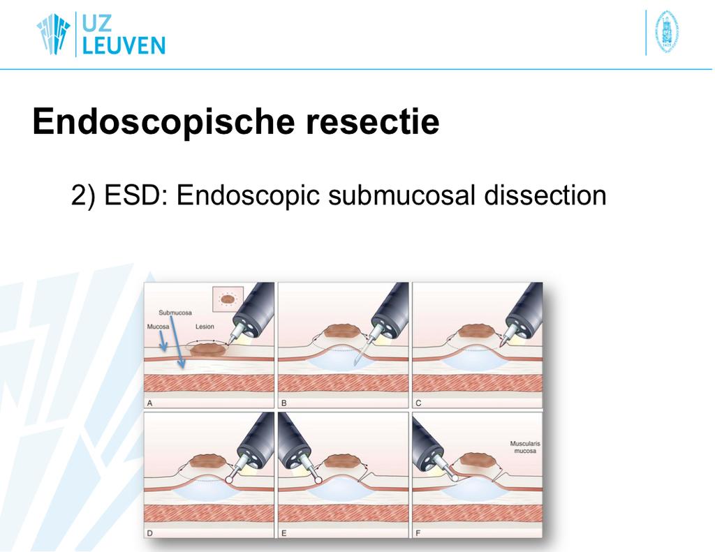 En bloc resec(on ESD is characterized by three steps: 1) injec(ng fluid into the submucosa to elevate the lesion from the muscle layer (zoals bij