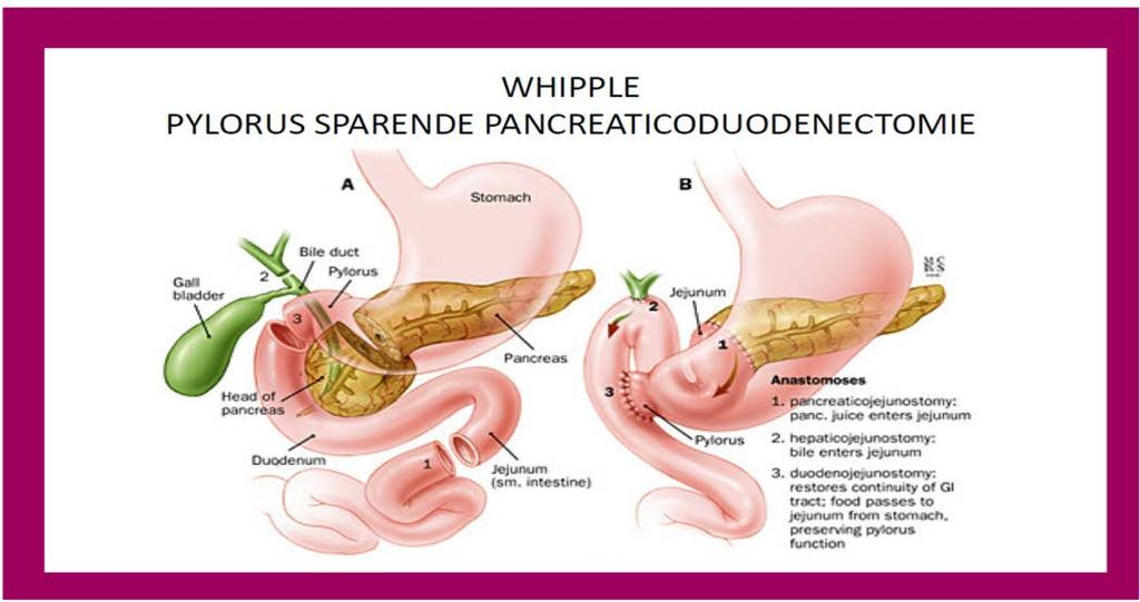 Exocriene pancreasinsufficiëntie (EPI) Het (resterende deel van het) pancreas functioneert niet optimaal / heeft onvoldoende capaciteit - > te weinig verteringssappen -> voedsel niet goed verteerd