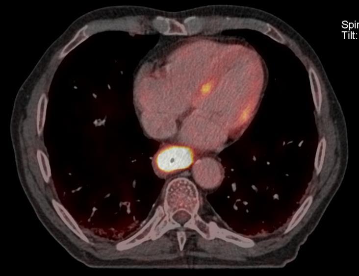 Diagnostiek: PET CT T stadium (T3/T4) tumor infiltratie wand N stadium
