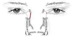 ingreep wordt door de oogarts en de KNOarts samen uitgevoerd. Endonasale DCR of externe DCR?