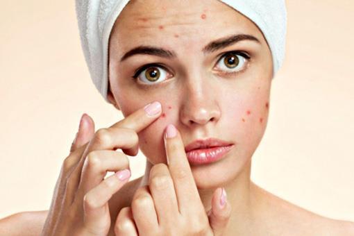 1.2.3 Acne behandeling voor de normale huid Acne word normaal gesproken aangeduid als acne vulgaris; een chronische huidziekte met een goedaardig verloop, gekarakteriseerd door een ontstekingsproces