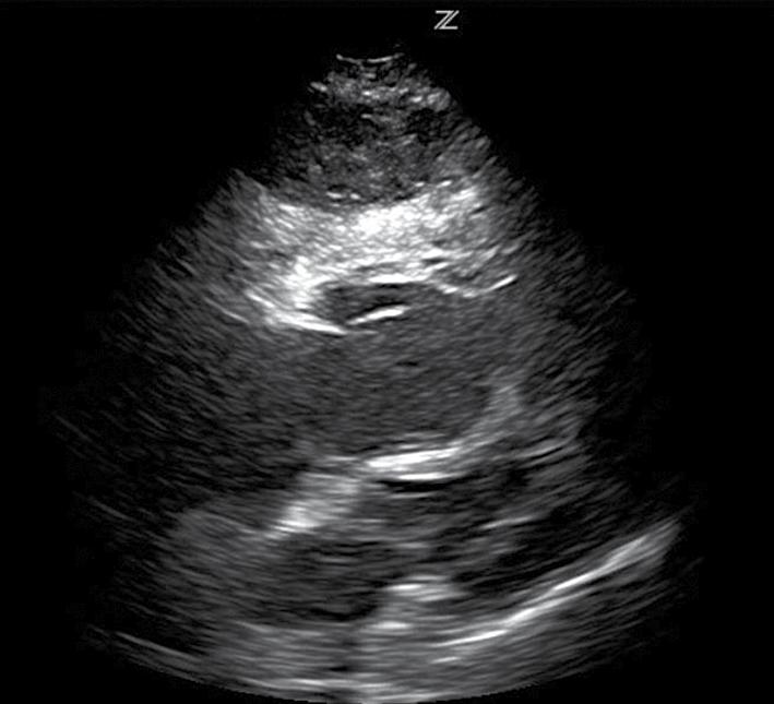 rechter atrium + ventrikel linker atrium linker ventrikel FIGUUR 1 Afbeelding van transthoracaal echografisch onderzoek van het hart van patiënt A, een 80-jarige vrouw.