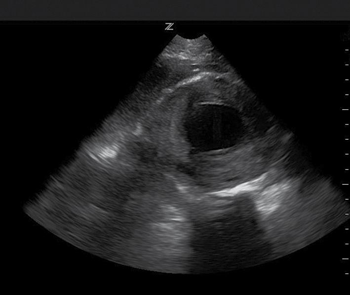 aortawand trombus FIGUUR 3 Afbeelding van echografisch onderzoek van de abdominale aorta van patiënt B, een 76-jarige man. Er is een aneurysma van de aorta met een diameter van bijna 8 cm.