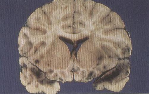 lineaire versnelling Licht versus zwaar hersenletsel COMA: ARAS Licht schedel-hersenletsel (commotio cerebri): korte bewusteloosheid door