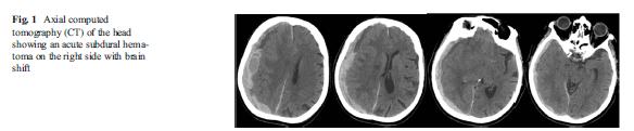 Ernstig schedel- hersenletsel bij de oudere Contusio cerebri Traumatisch intracerebraal hematoom