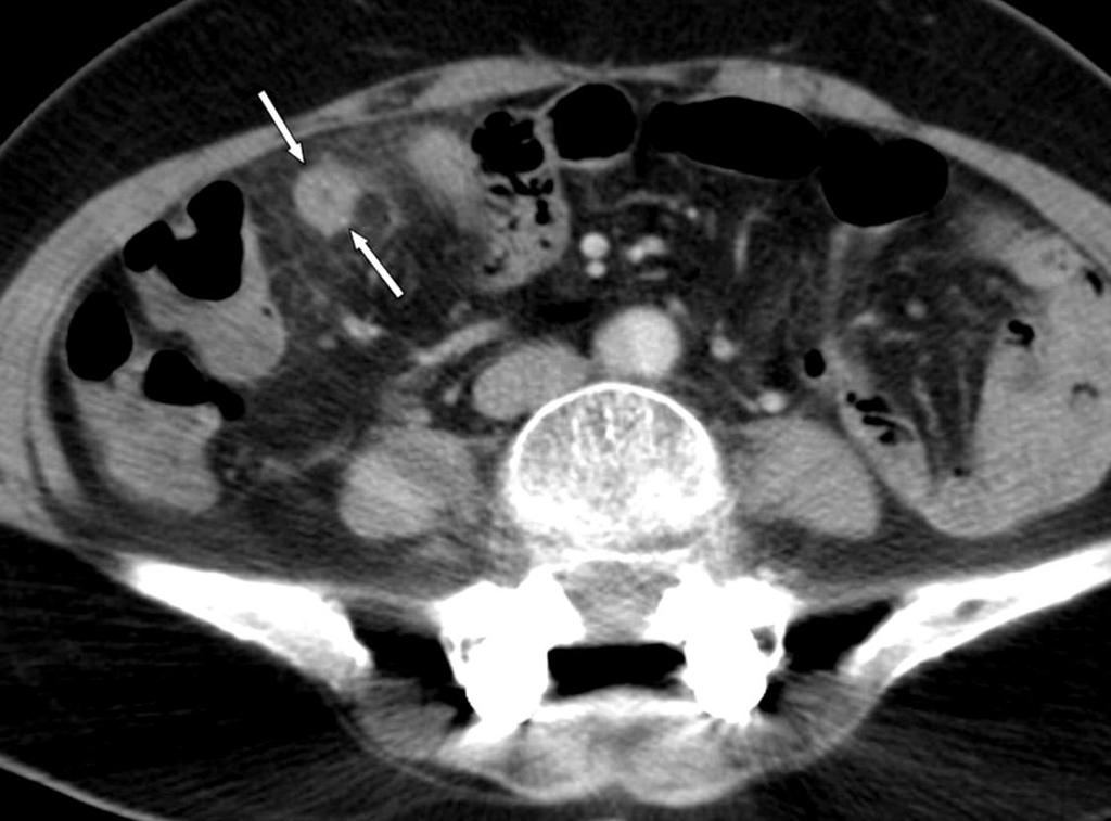 Beeldvorming Echografie Sensitiviteit 75% en specificiteit 90-100% Maar operator dependent!