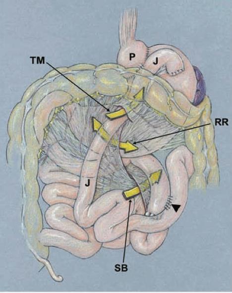A Internal hernia after RYGB B A.
