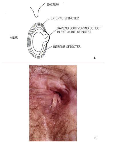 Behandeling anale fistel Intentie behandeling infectieus proces met maximaal bewaren van sfincter en minimale duur Fistulotomie,