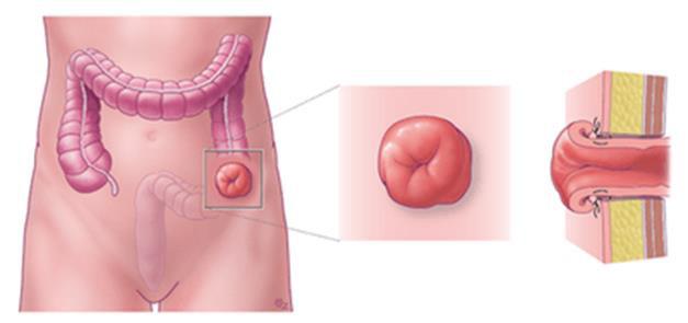 Colostoma Een colostoma is een kunstmatig gemaakte opening doorheen de buikwand, waarlangs een deel van de dikke darm naar buiten wordt gebracht.