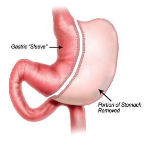 MINI GASTRIC BYPASS Deze operatie is een variant op de gewone Gastric Bypass. De operatie kenmerkt zich door een andere maag-darmverbinding, die wordt aangesloten op een lange, nauwe sleeve - pouch.