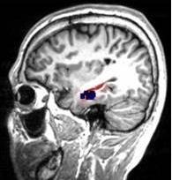 1: Resultaten MEG en HD-EEG in vergelijking met de VLEZ Tabel 4: Resultaten VLEZ, MEG en HD-EEG Patiënt 1 VLEZ