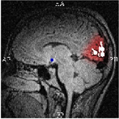 Het resultaat van de bronlokalisatie toonde 2 clusters van dipolen bij het MEG onderzoek, en een gescattered resultaat in de temporale kwab bij het HD-EEG onderzoek.