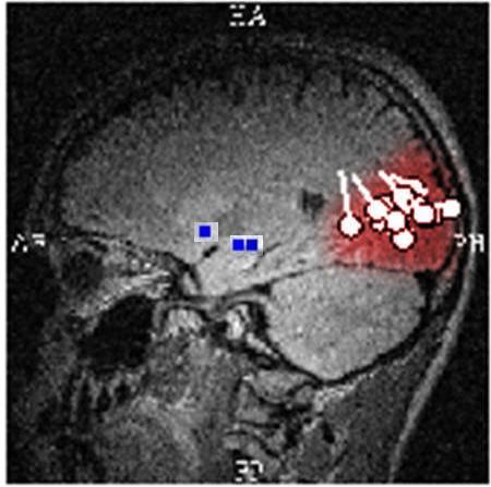 Op lobair en sublobair niveau kon er niet gesproken worden over een congruentie tussen de beide onderzoeken, aangezien HD-EEG een gescattered resultaat buiten de cortex en over de temporale kwab