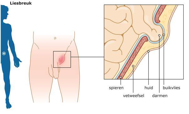 Wat is een liesbreuk? Een liesbreuk (= hernia inguinalis) is een uitstulping van het buikvlies door een zwakkere plek of opening (breuk) in de buikwand ter hoogte van het lieskanaal.