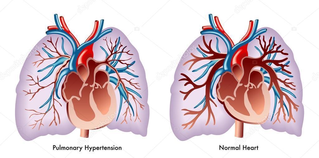 Pulmonale hypertensie Relatie