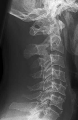 Operatie nekhernia via anterieure cervicale discectomie (ACDF) Tijdens de operatie verwijderen we de tussenwervelschijf en de hernia via de voorkant van de hals.