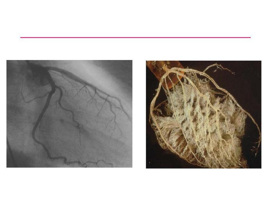 Vroeger: Syndroom X, verzamelnaam voor onbegrepen hartklachten bij vrouwen Tipje van de ijsberg bij hartcatheterisatie