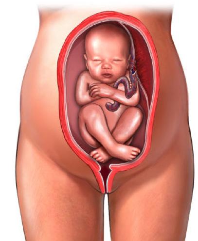 Daarnaast komt een stuitligging vaker voor bij: een meerlingzwangerschap, een afwijkende vorm van de baarmoeder of het bekken, een voorliggende placenta (moederkoek) of een myoom